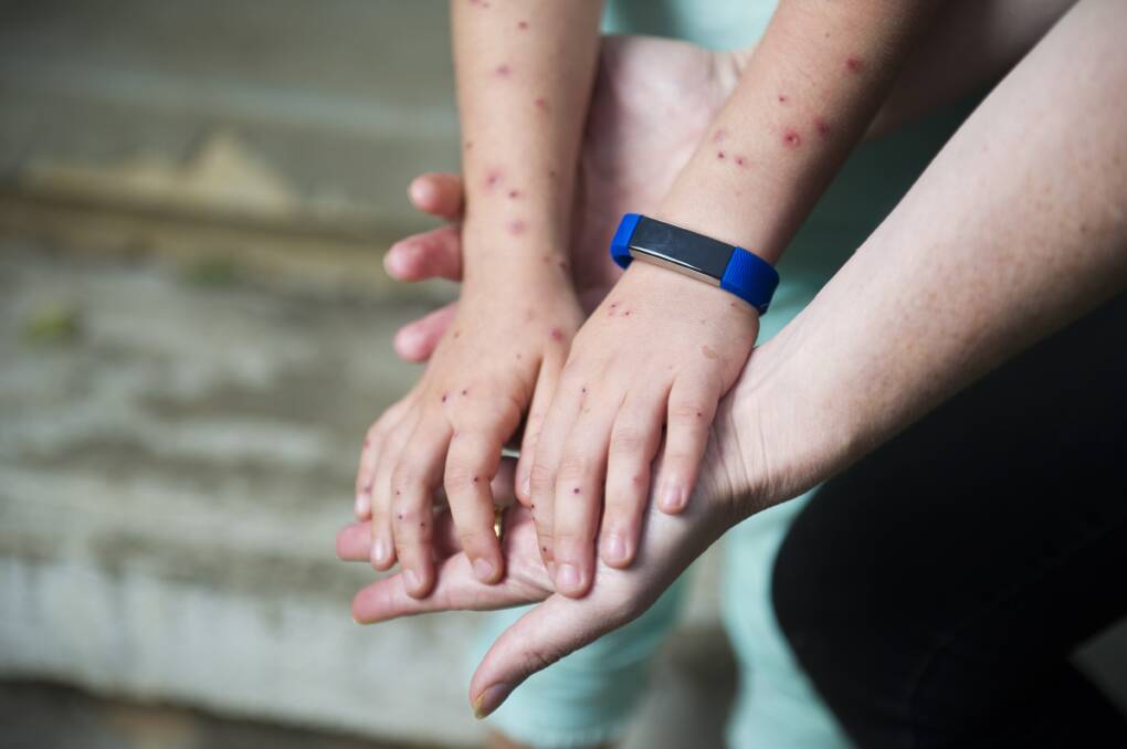 Samara Zeitsch holds her daughters hands showing the large number of wasp stings she received from the attack. Photo: Dion Georgopoulos