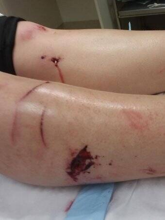 Michaela Vodvarka required 10 stitches after she was bitten by a wild pig. Photo: Supplied