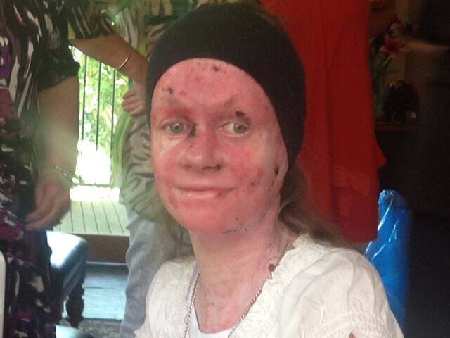 EB sufferer Kate Turner, who inspired Andrew to launch the Million Dollar Run. Photo: Facebook