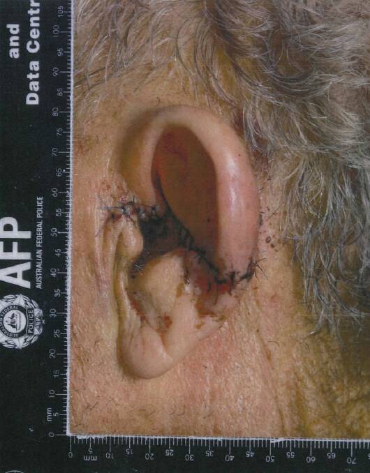 Damage to Ian Gore's ear. Photo: Supplied