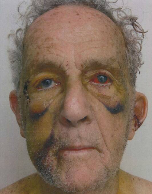 Photo of war veteran Ian Gore, 82, taken one month after he was bashed. Police say his injuries were some of the worst they've seen.  Photo: Supplied