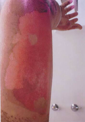 A photo of the victim's burns,  tendered in court.