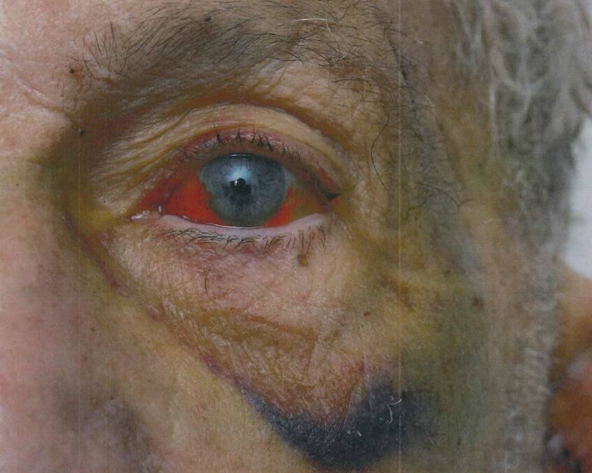 Ian Gore's eye. Photo: Supplied