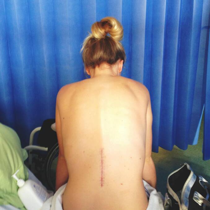 Emma Carey's back after surgery. Photo: Supplied