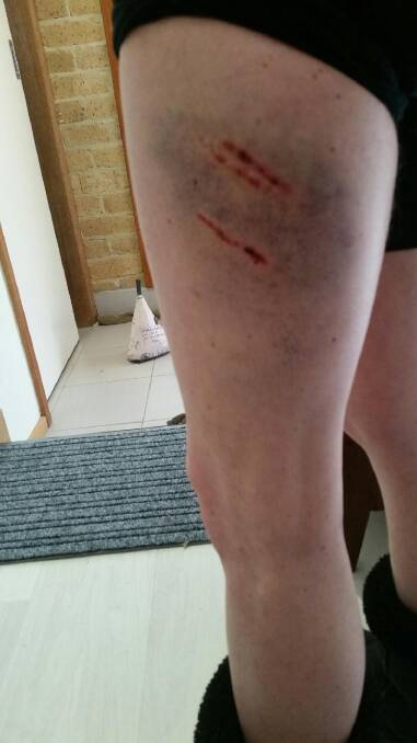 Photos of Livia Auer's injuries after she was attacked by a dog in Stirling last month. Photo: Livia Auer