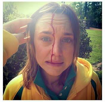 Natalie Medhurst's Twitter pic following the magpie attack.