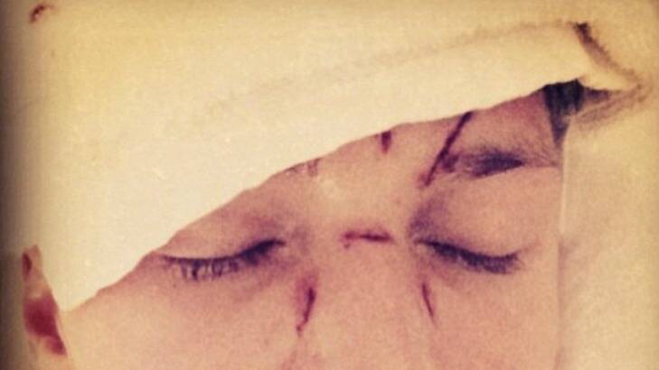 Barron Hilton's face after the alleged attack in Miami. Photo: Instagram
