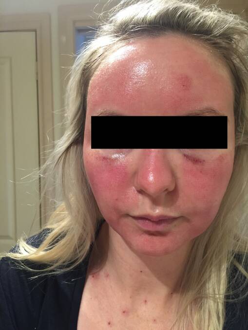 The woman said swelling began as the days went on Photo: Supplied