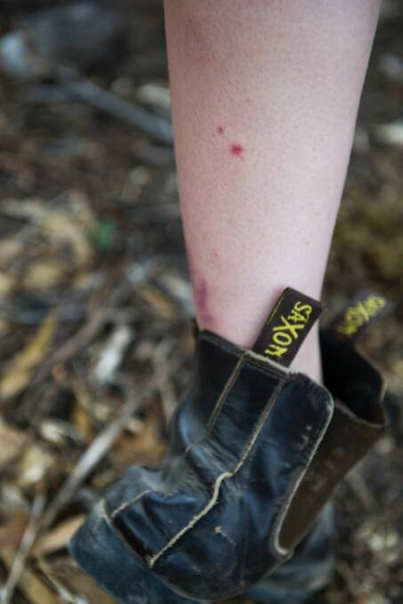 The bite marks of an brown snake on Tayla Ballard.  Photo: Elesa Kurtz