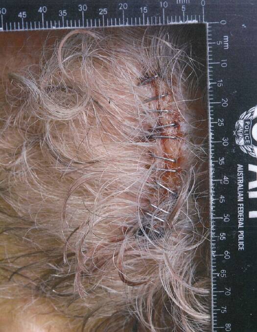 Ian Gore's scalp after the incident. Photo: Supplied