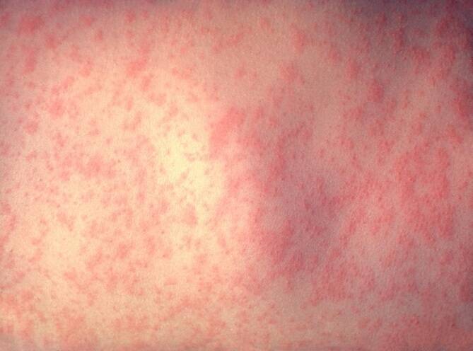 A typical measles rash. Photo: Supplied