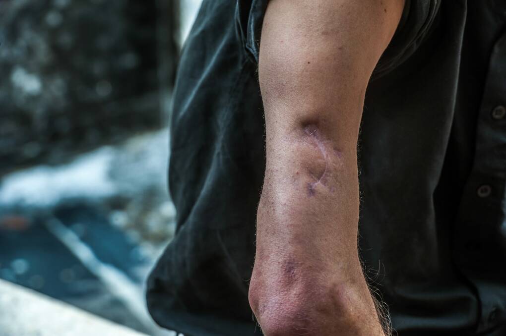 Daniel Meyers, who lost a finger in the attack, shows his other injuries. Photo: Karleen Minney