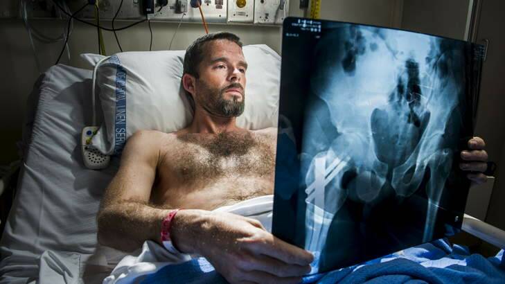 NOT SOMETHING THAT TICKLES: Guy Ravell looks at an X-ray of his injury. He snapped his pelvis in two in a skiing accident. Photo: Rohan Thomson