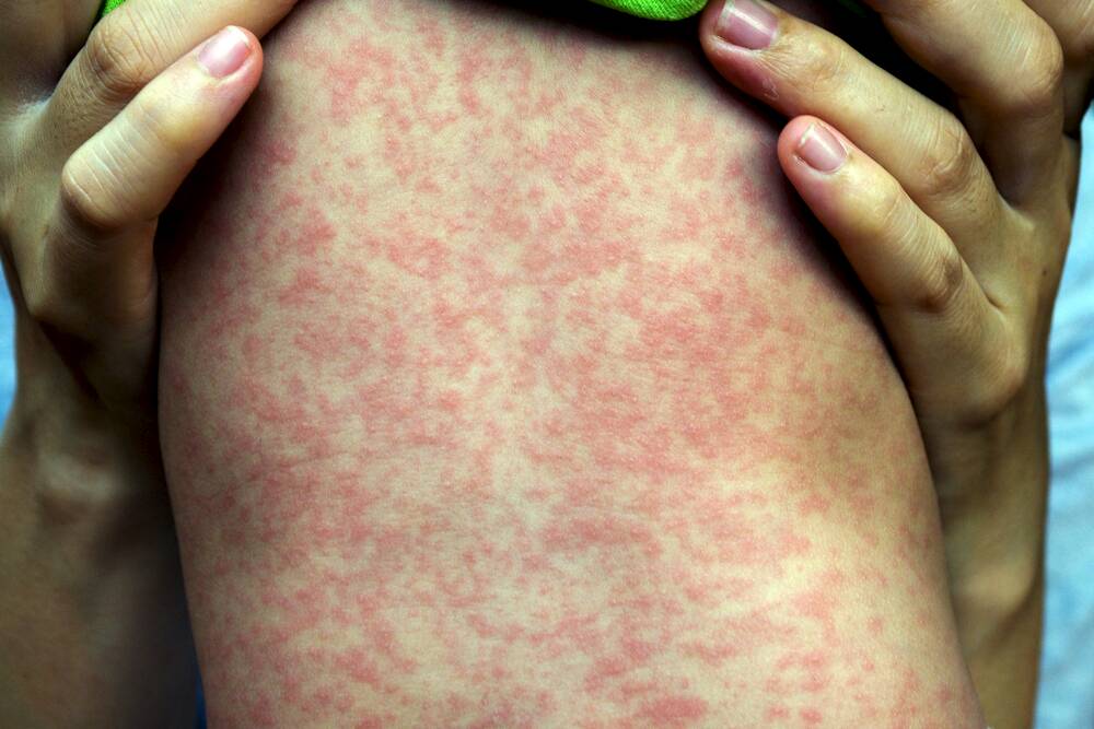 A third case of measles has been confirmed in Canberra Photo: Shutterstock