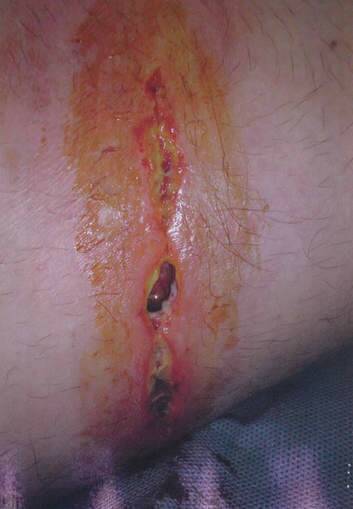 A photo of the victim's burns,  tendered in court.