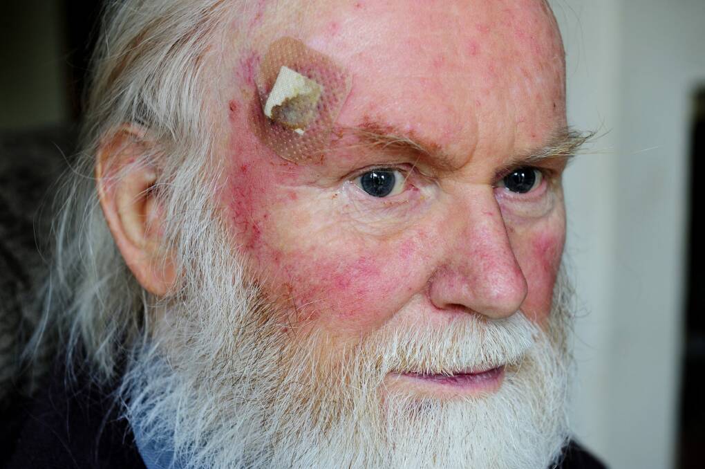 David Walker of Ainslie suffered cuts to his head and hand when he was assaulted after he paid to have his house number spray-painted on his driveway. Photo: Melissa Adams