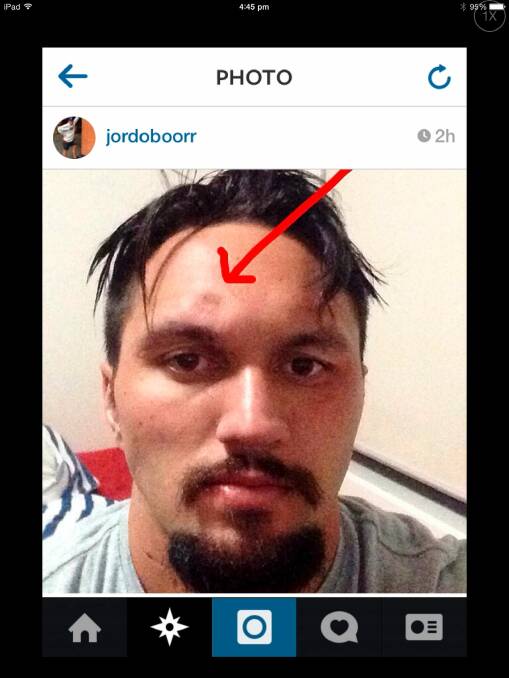Jordan Rapana's Instagram photo of his head injury, a fractured skull, in August.