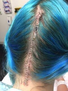 Canberra teenager Asha Miller after major brain surgery last year to help address the neurological disorder Chiari Malformation. The surgery did not require her to have her head shaved, so she dyed her hair blue for the occasion. She had 34 staples as a result of the surgery. Photo: Supplied
