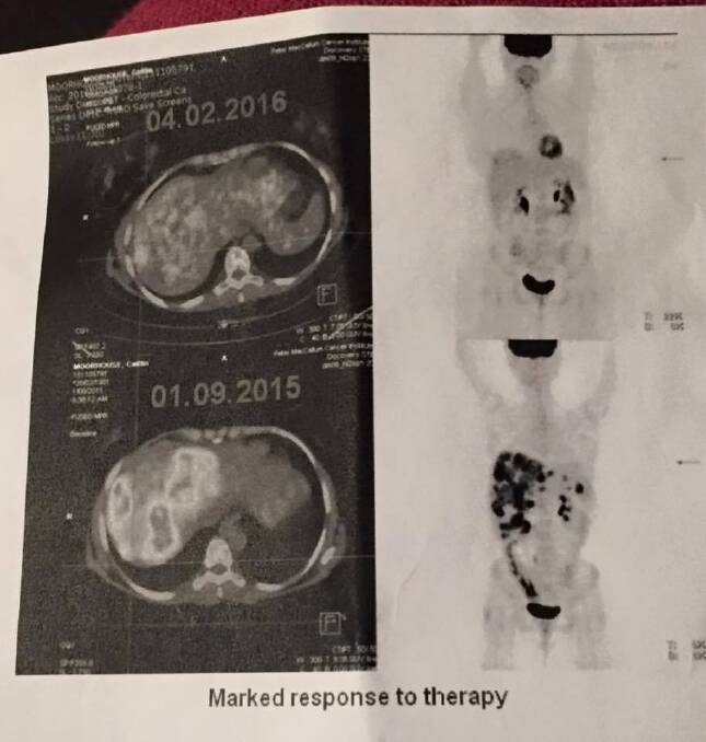 Caitlin Moorhouse's cancer scans. Photo: Supplied
