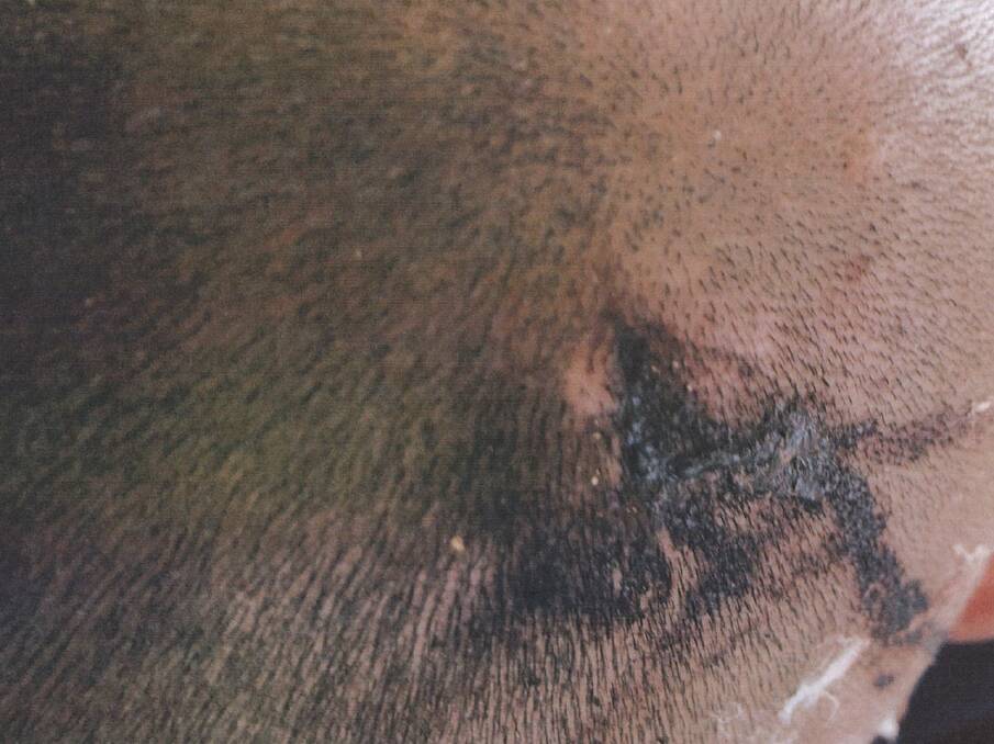 An injury suffered by Peter Zdravkovic when a bullet grazed his head in March 2018. Picture: Supplied