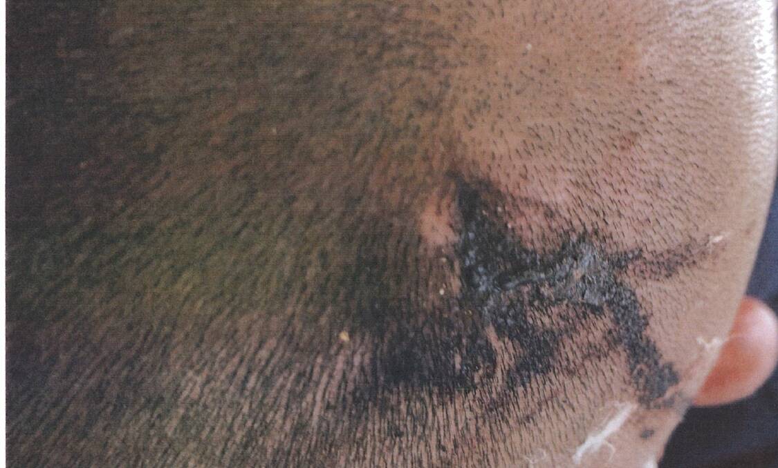 A head injury that Peter Zdravkovic claims came from a bullet in March 2018. Picture: Supplied