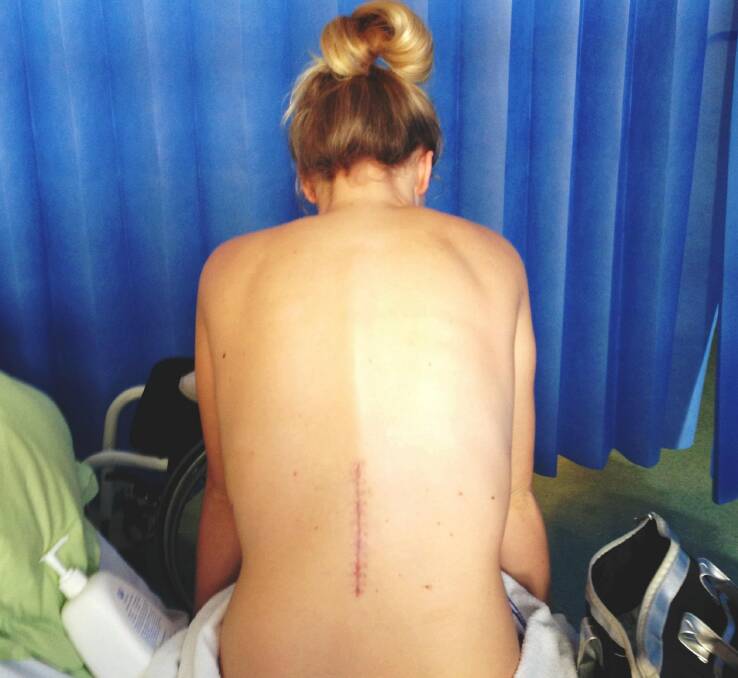 Emma Carey's back after surgery. Picture supplied