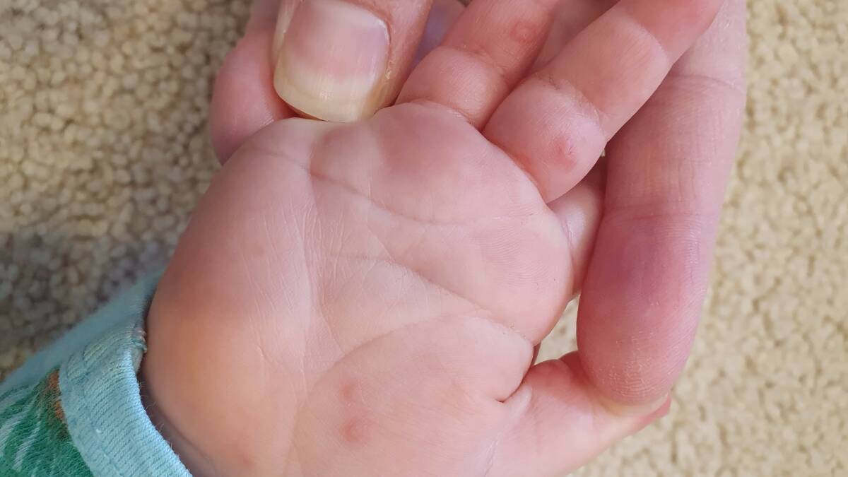 Harry Sliwinski's hand, foot and mouth disease. Picture: Kathryn Sliwinski