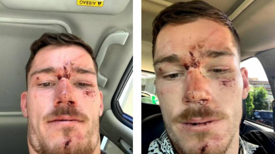 Tom Starling was left battered and bruised after his run in with police in December.