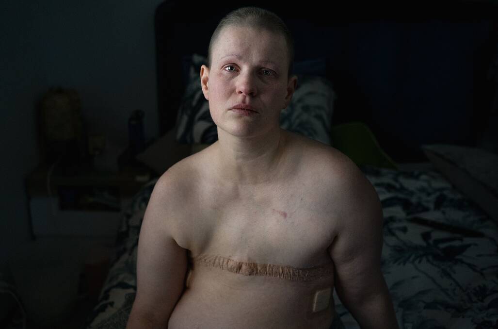 Breast cancer, age 37, by Cat Leedon. Picture: Supplied
