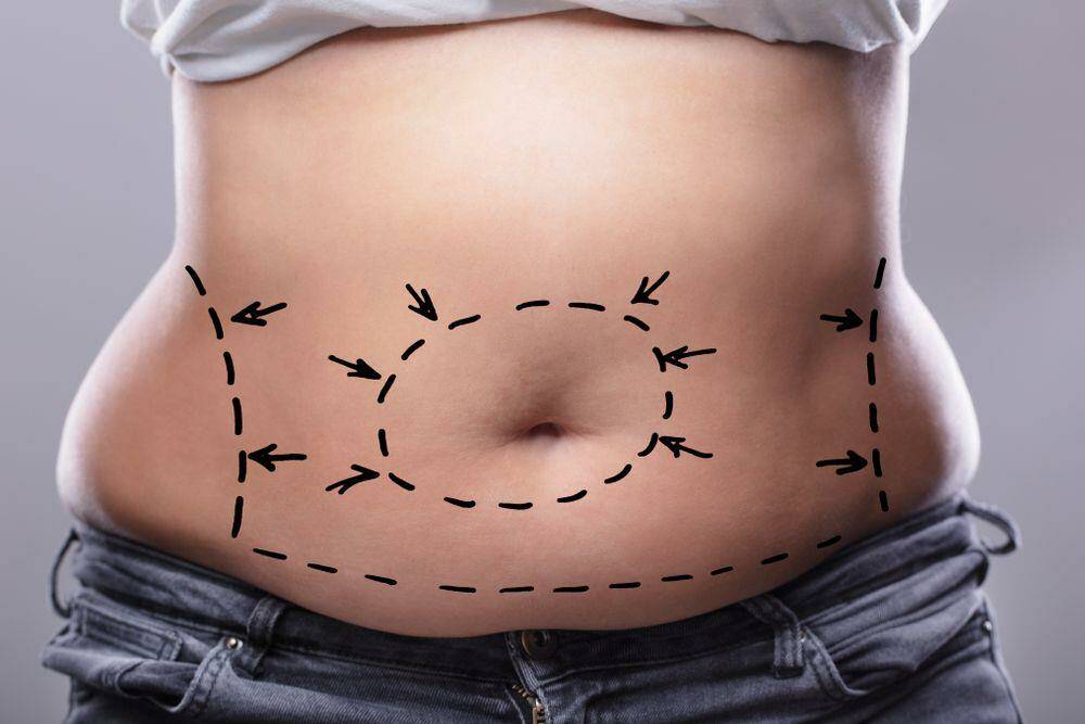 What to expect during liposuction surgery