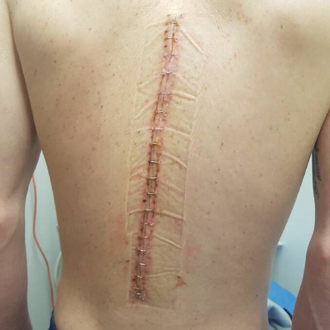 Canberra jockey John Kissick shows the scare on his back after surgery.
