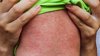 A NSW baby boy with a recently confirmed case of measles.