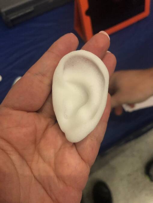 An ear implant like this one would be made from a 3D scan of Garrett Megelkamp's other ear.