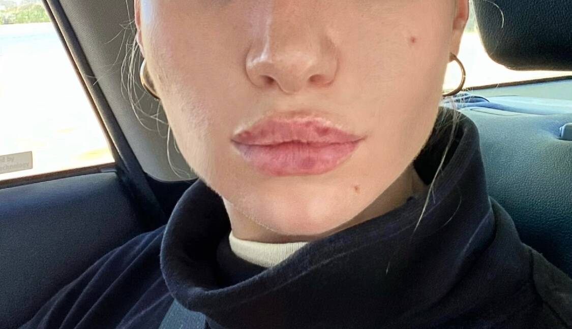 Dermal fillers which involves injecting a gel substance into the skin to add volume usually results in swelling post-procedure. Picture: Supplied