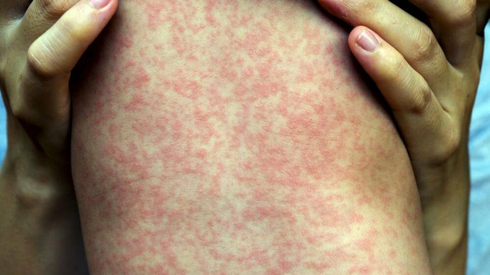 Measles is particularly dangerous for children. Photo: Shutterstock