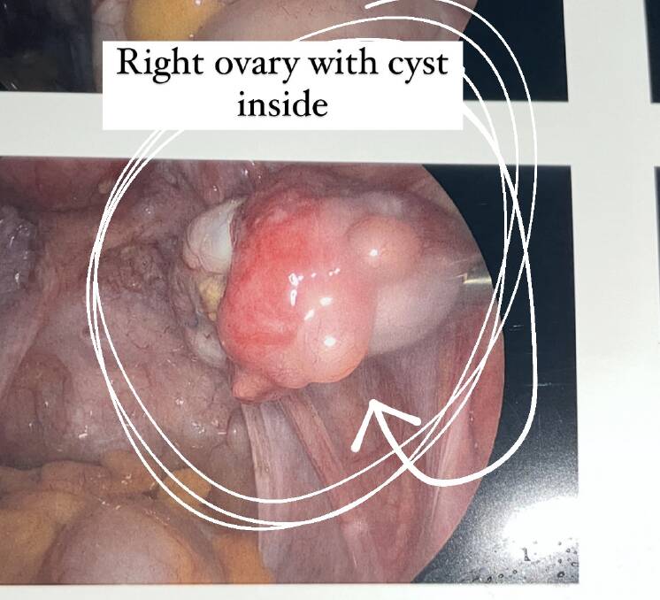 Image taken from inside Erin Barnett showing a cyst on her ovary. Picture: Supplied