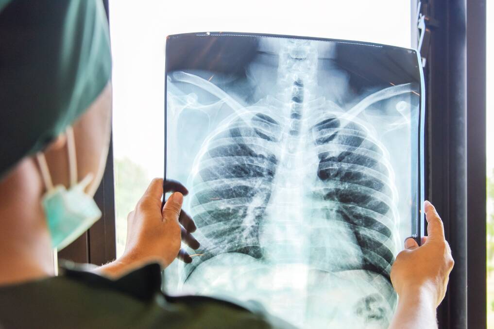 SERIOUS: Nearly 1.7 million people worldwide, or 4000 a day, will die of tuberculosis this year. Picture: Shutterstock