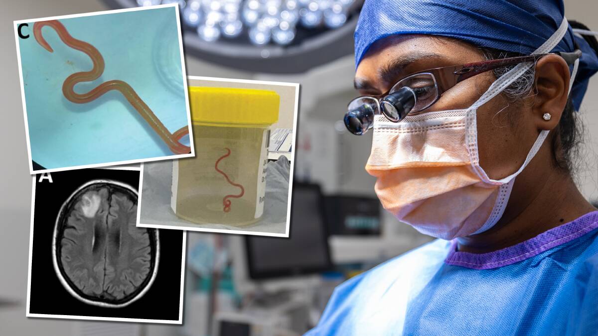 Canberra neurosurgeon Hari Priya Bandi and a worm she took from a woman's brain. Pictures supplied