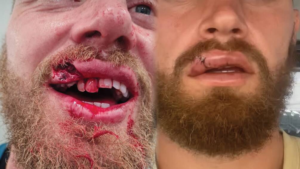 Raiders co-captain Elliott Whitehead before and after surgery.