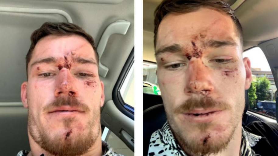 Raiders hooker Tom Starling after he'd been "assaulted" by NSW police on the Central Coast. Picture supplied