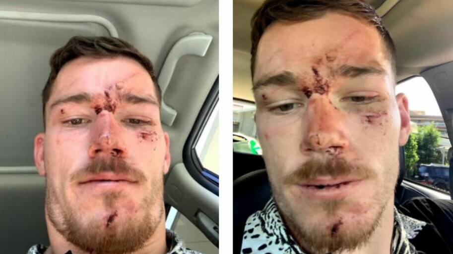 The NSW Police officers who did this to Raiders player Tom Starling are being investigated. Pictures supplied