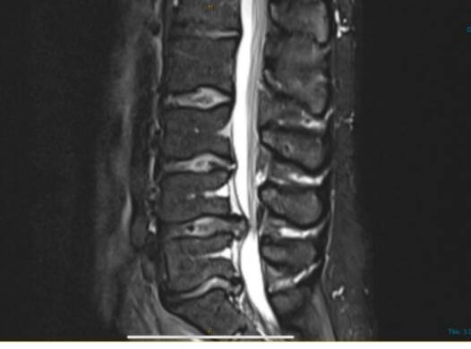 An MRI scan shows the protruding L4,5 disc protruding in Cooke's back. Picture: Supplied
