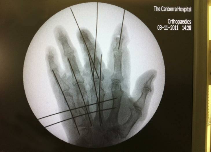 Hand x-ray. Photo: Supplied