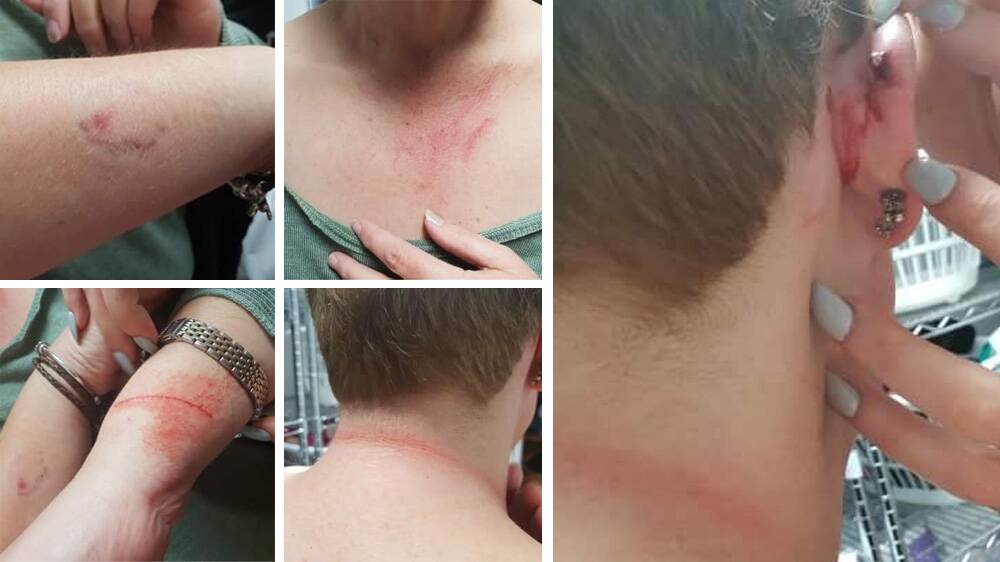 Photos supplied by the union showing injuries sustained at work in the adult mental health unit last week.  Photo: Supplied