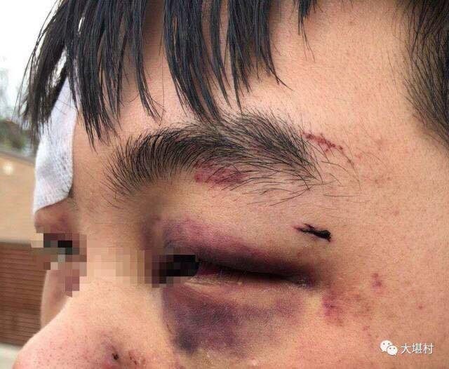 A Chinese student allegedly assaulted in Canberra's south last week. The photo was taken by friends of the victim. Photo: Supplied