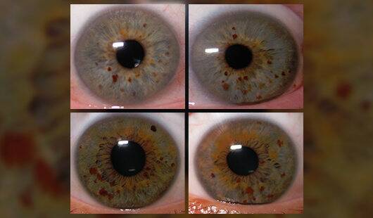Do Specks in the Iris Really Warn About Health?