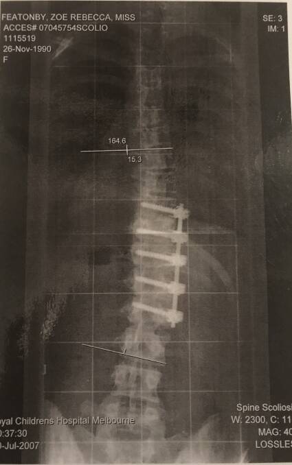 Featonby has a titanium rod and five screws in her spine as the result of severe scoliosis. Photo: Supplied