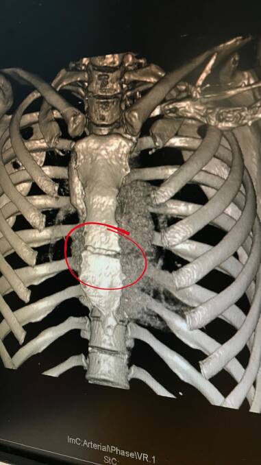 Medical images of the crack in Caroline Buchanan's sternum. Photo: Supplied Photo: Supplied