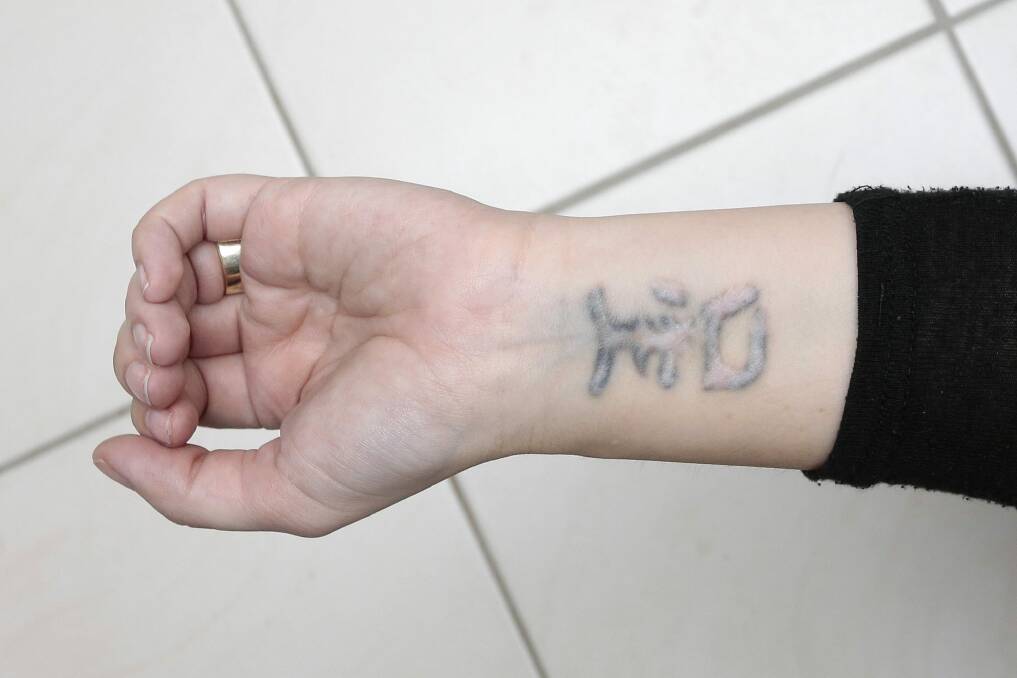 Jay Gill's partially removed tattoo. Photo: Jeffrey Chan