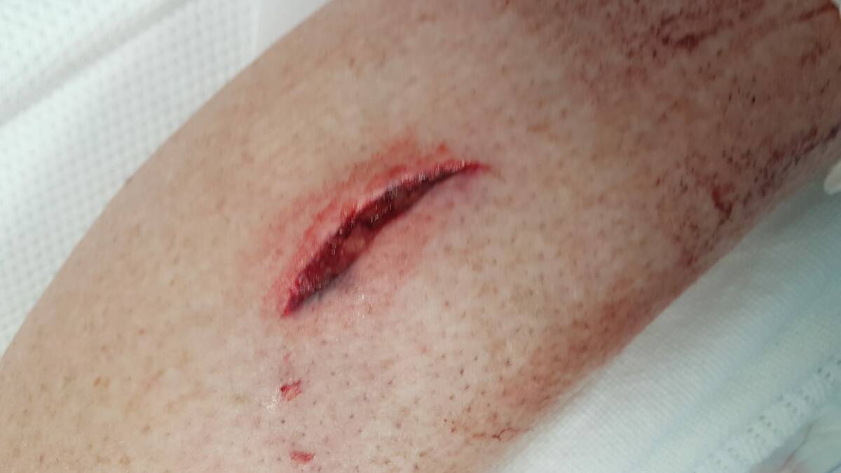 One of the bites Banks woman Kerry Evans sustained when she was attacked by a wombat. Photo: Dave Evans